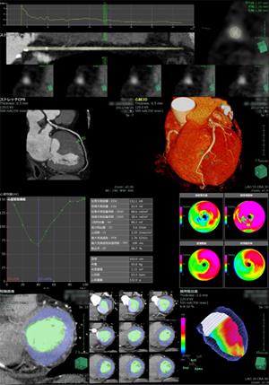 画像：冠状動脈および心機能解析