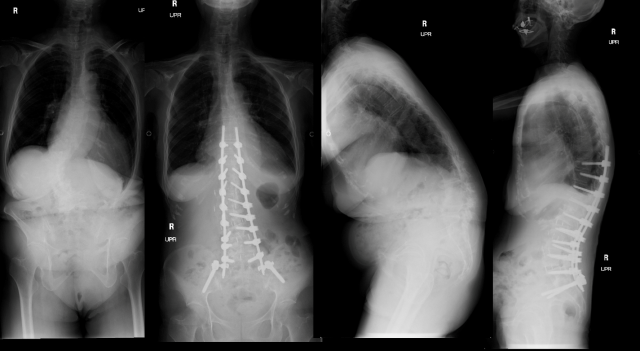 最小侵襲脊椎矯正固定術（T10-骨盤固定）の画像1