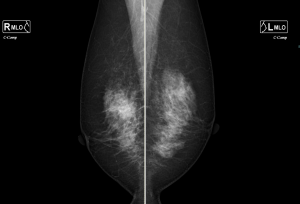 マンモグラフィ③